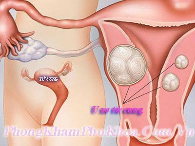 Bệnh u xơ tử cung ở phụ nữ là gì