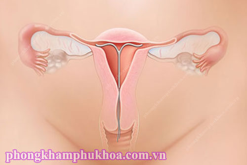 Đặt vòng tránh thai gây ra ảnh hưởng gì?