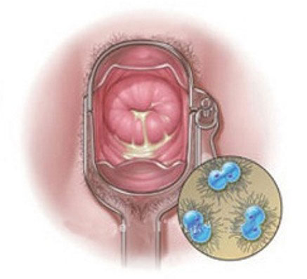 Hình ảnh bệnh lậu ở nữ giới