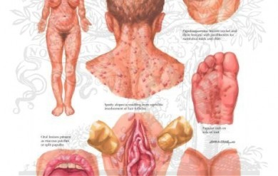 Tổng hợp hình ảnh các ị trí biểu hiện của bệnh giang mai