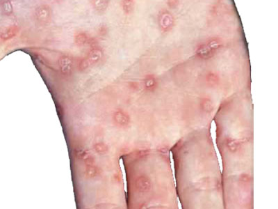 Giai đoạn 1 săng giang mai Giai đoạn 1 săng giang mai