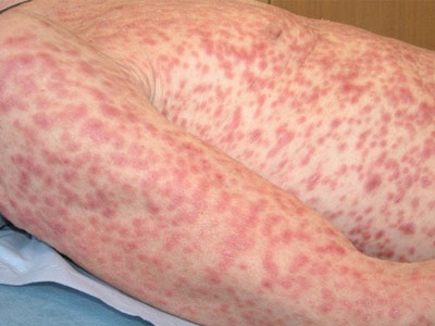 Giai đoạn 2 – Đào ban giang mai Giai đoạn 2 – Đào ban giang mai