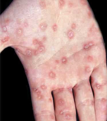 Săng giang mai Săng giang mai