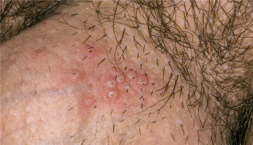 Hình ảnh mụn rộp sinh dục ở nam giới