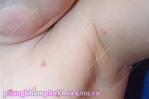 Hình ảnh nốt sùi mào gà ở trẻ nhỏ Hình ảnh nốt sùi mào gà ở trẻ nhỏ