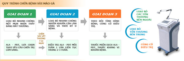 Quy trình chữa bệnh sùi mào gà tại phòng khám Hưng Thịnh